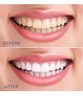 Teeth trousse professionnelle de blanchiment pour utilisation à domicile, Easy System For The Perfect Smile