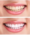 28 Blanchiment des dents Strips | NEW 30 min. Exprimez | Beau sourire Premium Line Professional Quality - Teeth Kit de blanchime