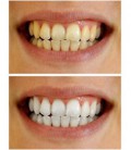 Blanchiment des dents Gel Seringues 44% de peroxyde de carbamide de blanchiment des dents Gel Dispensers