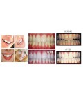 5 XL 38% Dentiste Recommandé à haute intensité de blanchiment des dents Gel Pro Dental Lab Direct! La plus haute qualité de pero